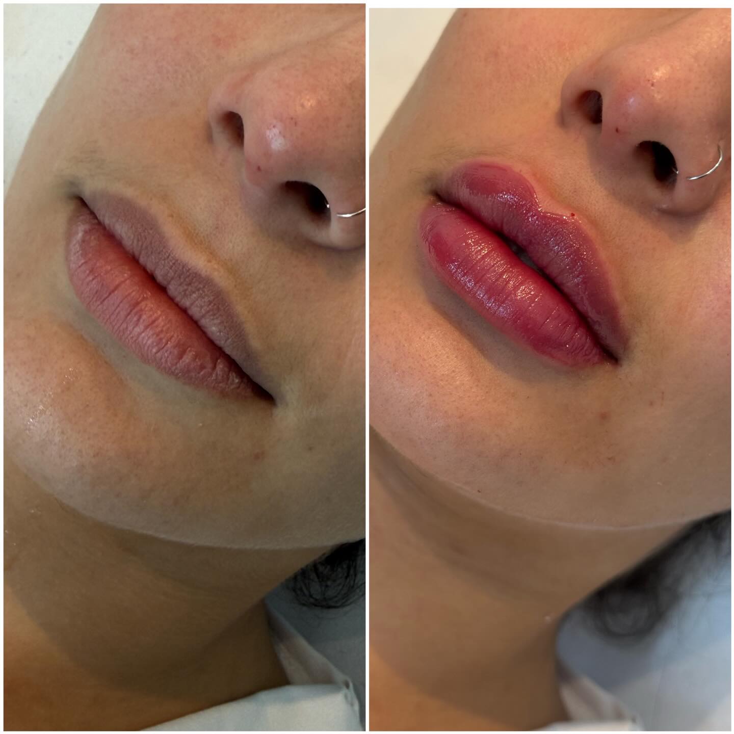 Publicação original do Instagram com duas imagens comparativas da região dos lábios