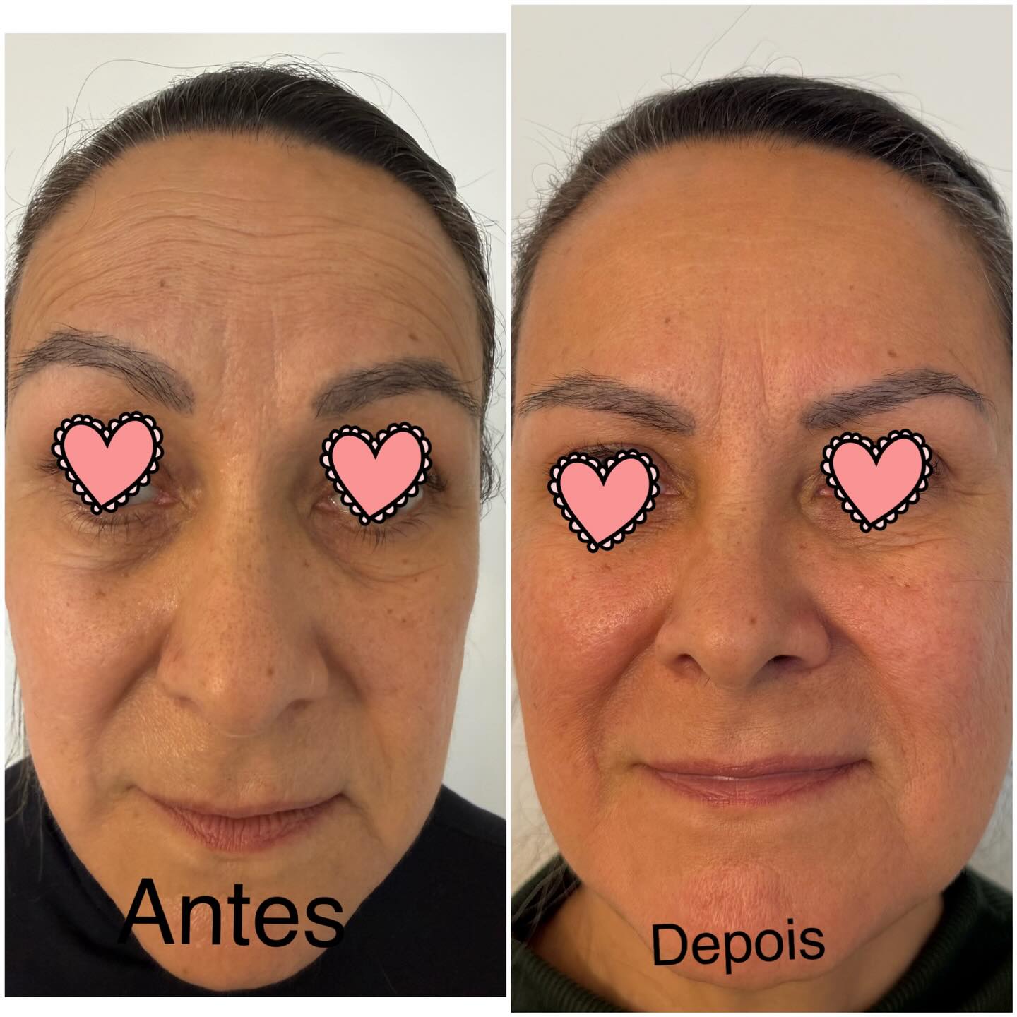 Publicação original do perfil de Andréia Carraro com imagens faciais identificadas como Antes e Depois